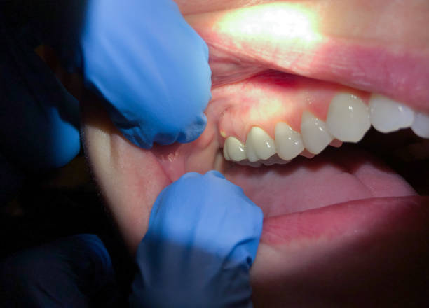 Best Emergency Dentist for Lost Fillings or Crowns in Zapata, TX